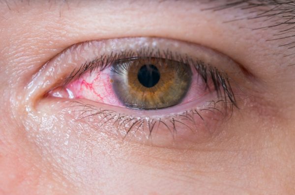 Natural solution to treat pink eye infections fast